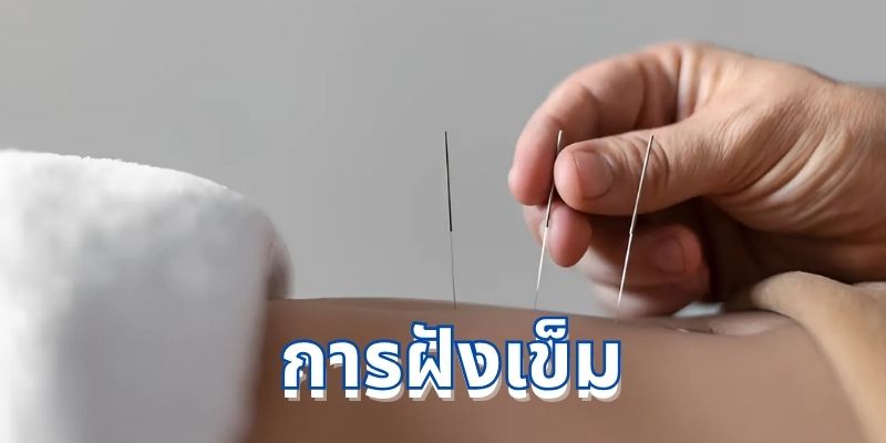 การฝังเข็ม: ศาสตร์แห่งการรักษาเพื่อสุขภาพที่สมดุล