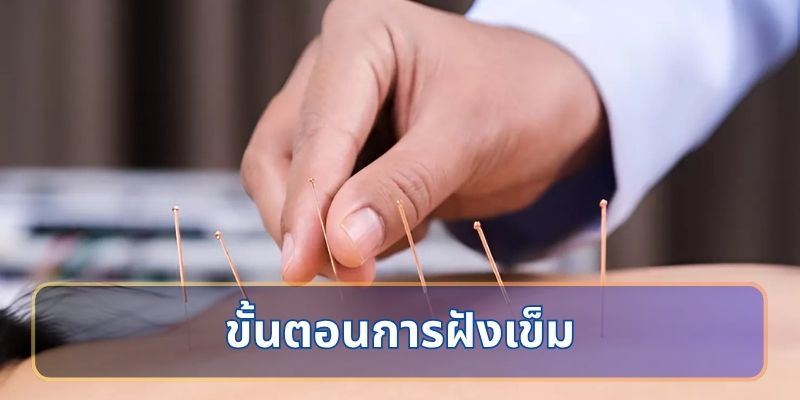 ขั้นตอนการฝังเข็ม