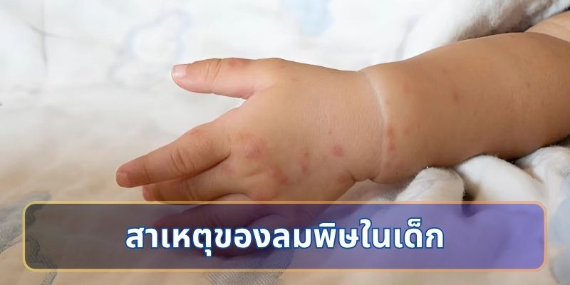 สาเหตุของลมพิษในเด็ก